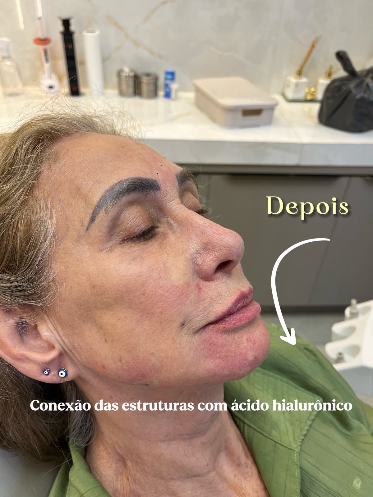 Harmonização Facial – Depois