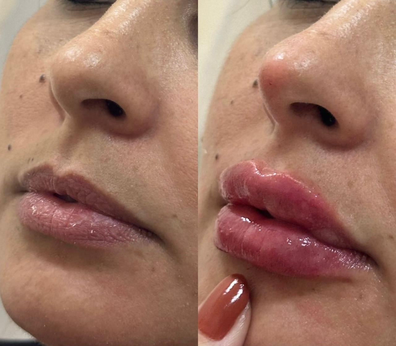 Preenchimento Labial – Antes e Depois