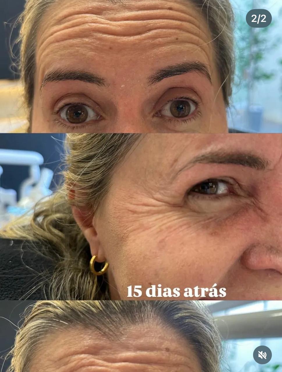 Botox – Antes