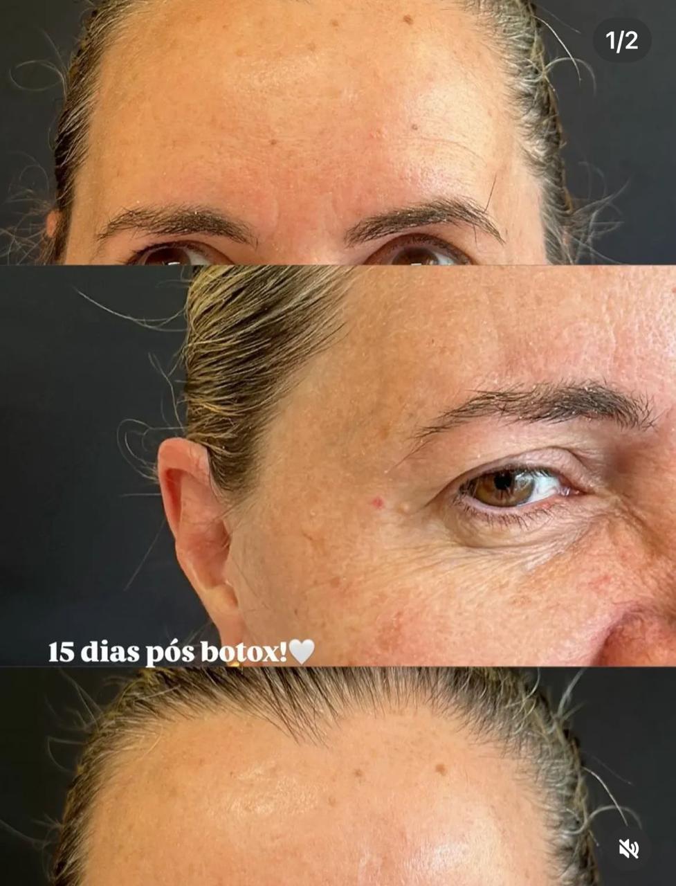 Botox – 15 dias depois